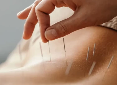 Acupuncture for Muscle and Nerve Pain